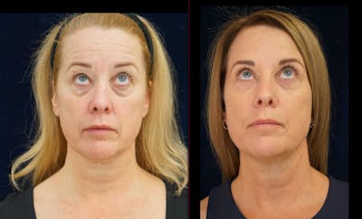 Blepharoplasty Before & After Gallery - Patient 404097 - Image 4