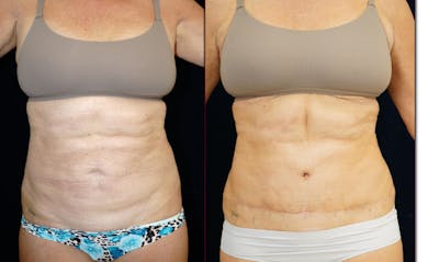 Abdominoplasty Before & After Gallery - Patient 366466 - Image 1