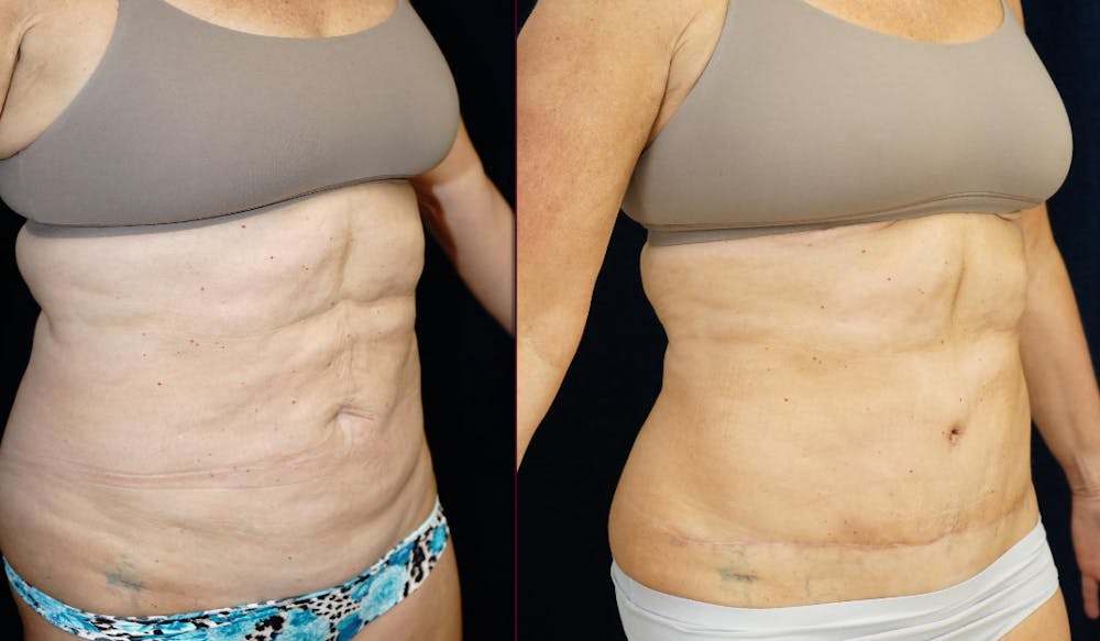 Abdominoplasty Before & After Gallery - Patient 366466 - Image 2