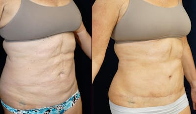 Abdominoplasty Before & After Gallery - Patient 366466 - Image 2