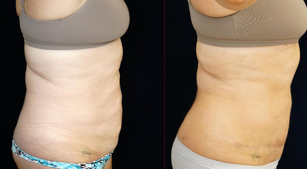 Abdominoplasty Before & After Gallery - Patient 366466 - Image 3