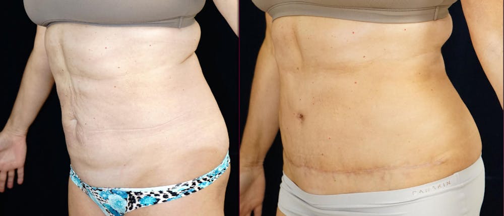 Abdominoplasty Before & After Gallery - Patient 366466 - Image 4