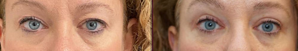 Blepharoplasty Before & After Gallery - Patient 250564 - Image 1