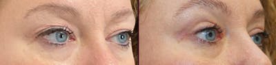 Blepharoplasty Before & After Gallery - Patient 250564 - Image 2
