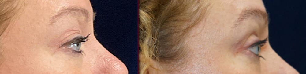 Blepharoplasty Before & After Gallery - Patient 250564 - Image 3