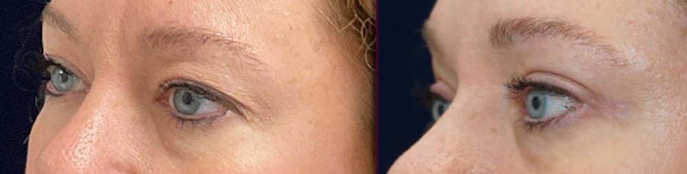 Blepharoplasty Before & After Gallery - Patient 250564 - Image 4