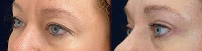 Blepharoplasty Before & After Gallery - Patient 250564 - Image 4