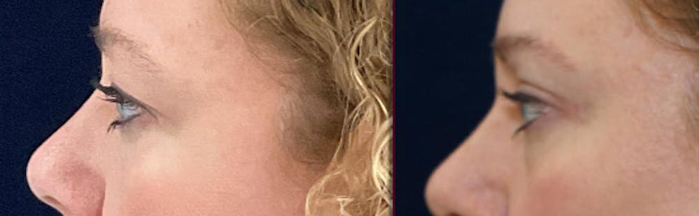 Blepharoplasty Before & After Gallery - Patient 250564 - Image 5