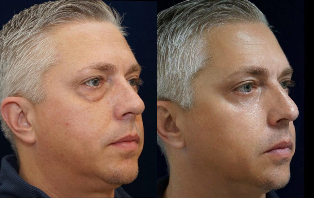 Blepharoplasty Before & After Gallery - Patient 240536 - Image 3