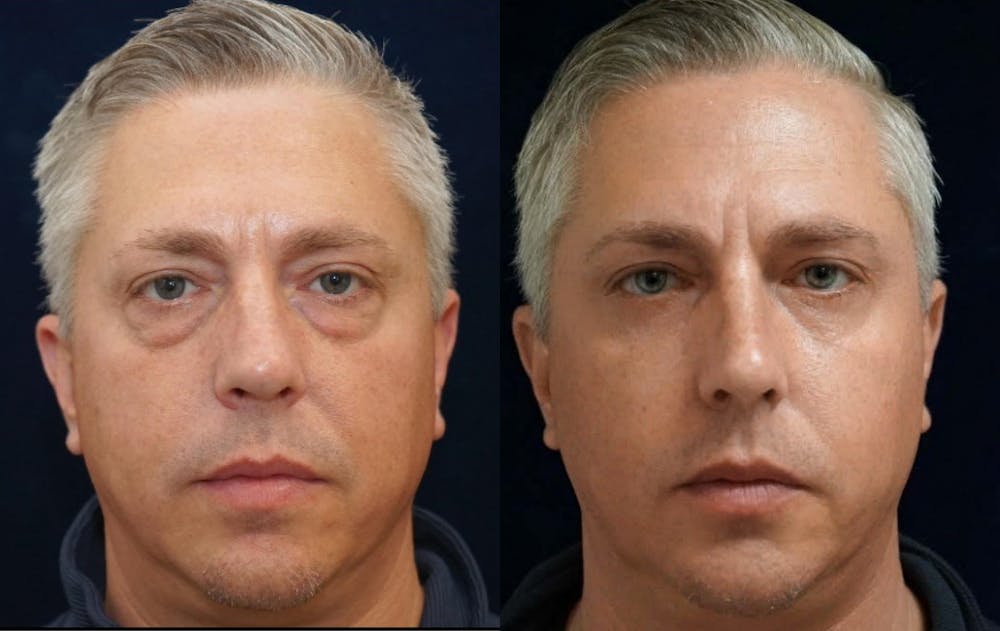 Blepharoplasty Before & After Gallery - Patient 240536 - Image 1