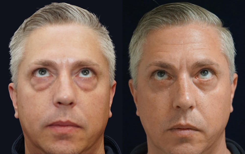 Blepharoplasty Before & After Gallery - Patient 240536 - Image 2