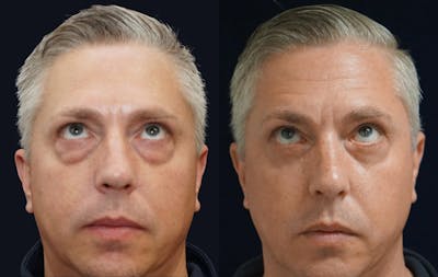 Blepharoplasty Before & After Gallery - Patient 240536 - Image 2