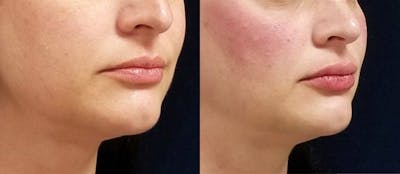 Lip Filler Before & After Gallery - Patient 87151477 - Image 2