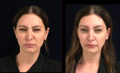DAXXIFY Before & After Gallery - Patient 174018762 - Image 2