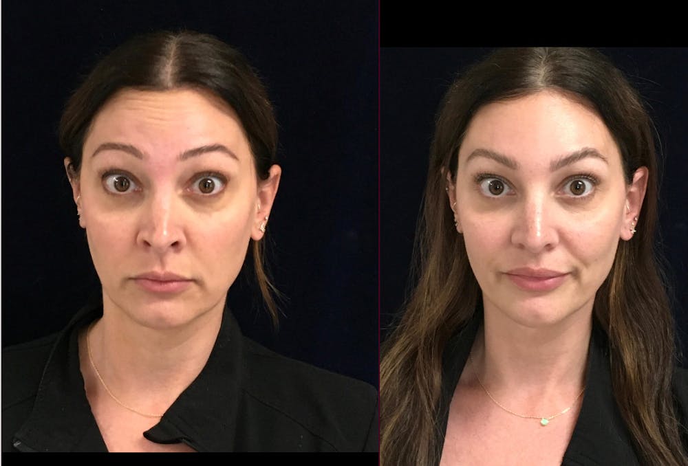 DAXXIFY Before & After Gallery - Patient 174018762 - Image 1