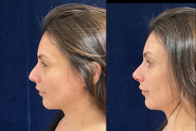 Liquid Rhinoplasty Before & After Gallery - Patient 245880 - Image 2