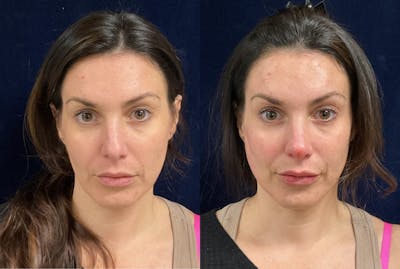 Liquid Rhinoplasty Before & After Gallery - Patient 245880 - Image 1