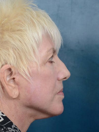 Deep Plane Facelift Before & After Gallery - Patient 4520758 - Image 6