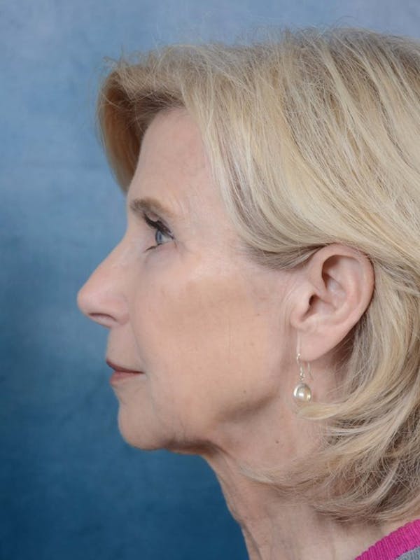 Deep Plane Facelift Before & After Gallery - Patient 4520759 - Image 5
