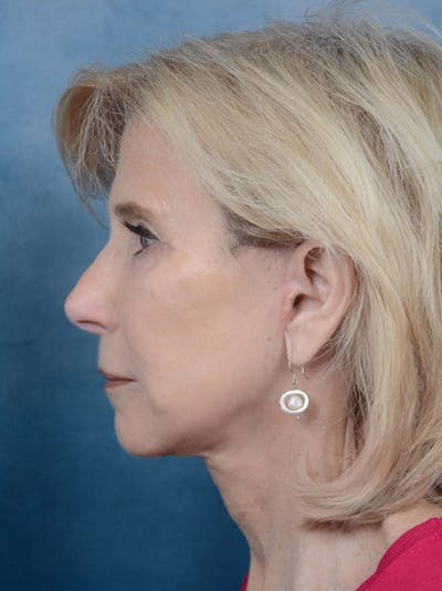 Deep Plane Facelift Before & After Gallery - Patient 4520759 - Image 6