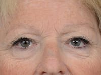 Eyelid Lift Before & After Gallery - Patient 4521015 - Image 1