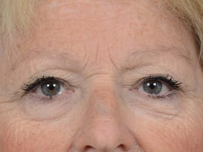 Upper Eyelid Lift Before