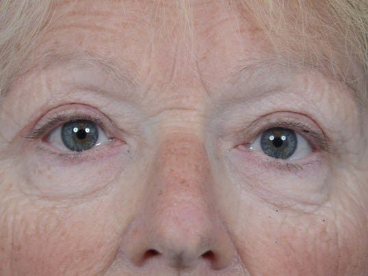 Eyelid Lift