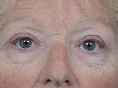 Eyelid Lift Before & After Gallery - Patient 4521015 - Image 2