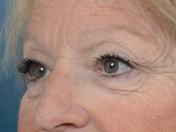 Eyelid Lift Before & After Gallery - Patient 4521015 - Image 3