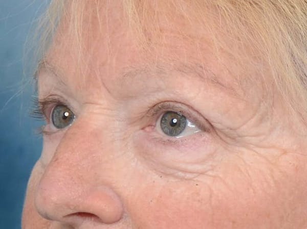 Eyelid Lift Before & After Gallery - Patient 4521015 - Image 4