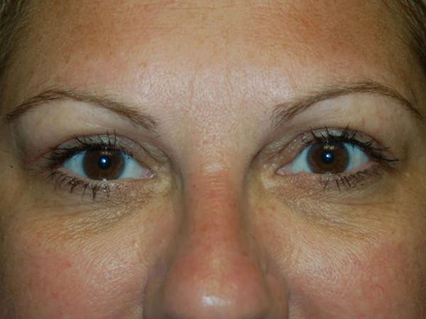 Eyelid Lift Before & After Gallery - Patient 4521016 - Image 2