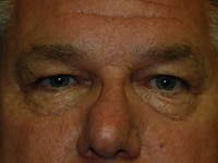 Eyelid Lift Before & After Gallery - Patient 4521017 - Image 1