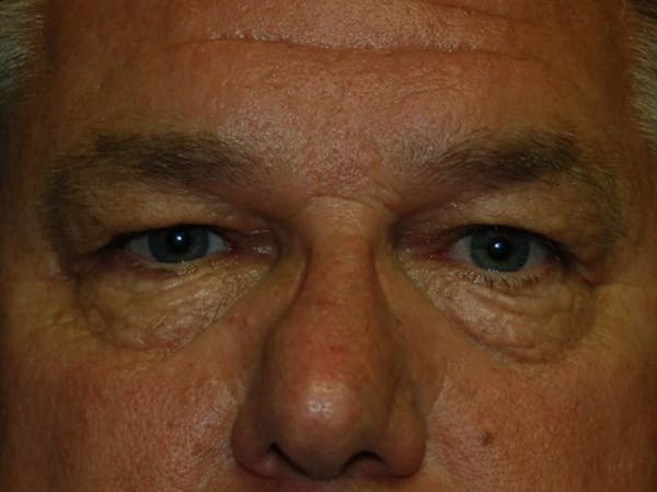 Eyelid Lift Before & After Gallery - Patient 4521017 - Image 1