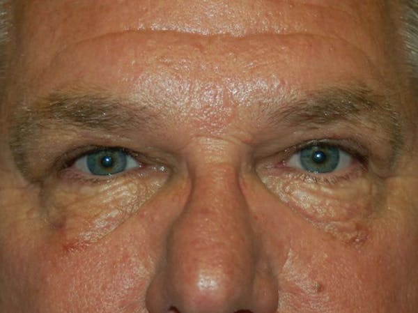 Eyelid Lift Before & After Gallery - Patient 4521017 - Image 2