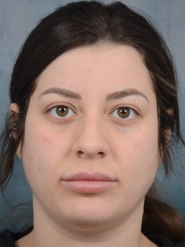 Rhinoplasty Before & After Gallery - Patient 4521036 - Image 5