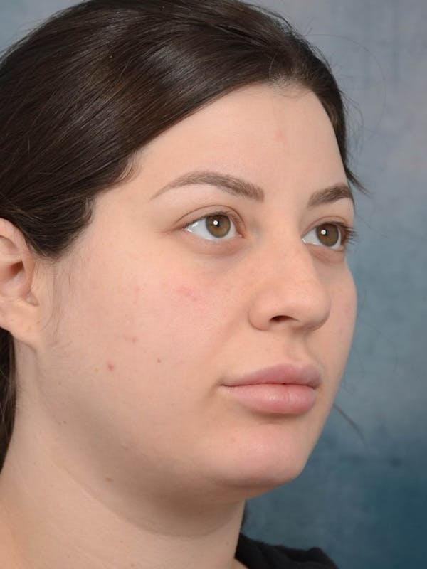 Rhinoplasty Before & After Gallery - Patient 4521036 - Image 3