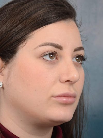 Rhinoplasty Before & After Gallery - Patient 4521036 - Image 4