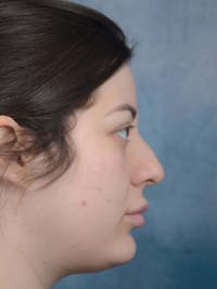 Rhinoplasty Before & After Gallery - Patient 4521036 - Image 1