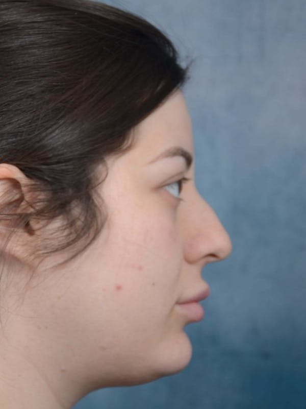 Rhinoplasty Before & After Gallery - Patient 4521036 - Image 1