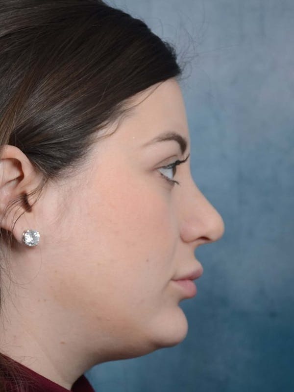 Rhinoplasty Before & After Gallery - Patient 4521036 - Image 2