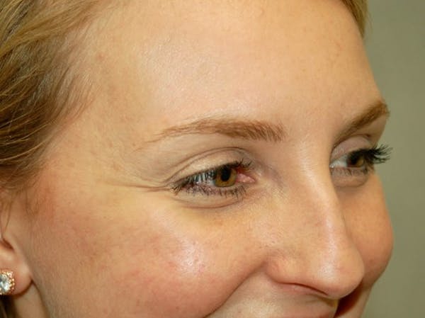 BOTOX Before & After Gallery - Patient 4521043 - Image 1