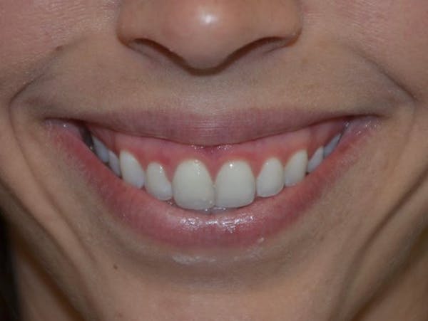BOTOX Before & After Gallery - Patient 4521044 - Image 1