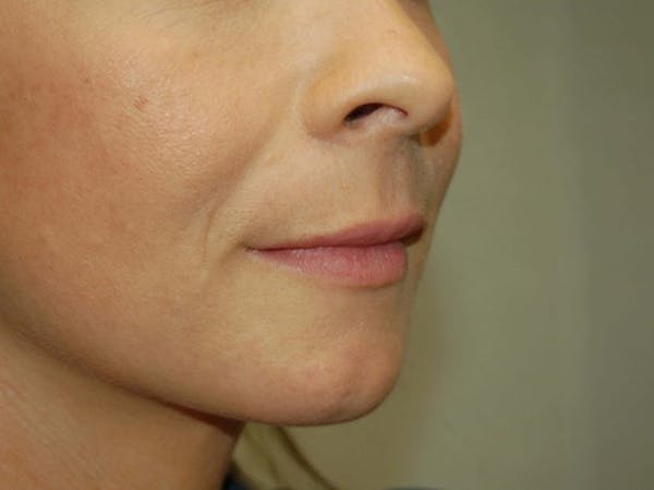 Juvéderm Before & After Gallery - Patient 4521052 - Image 3