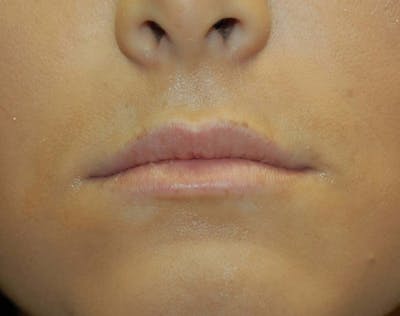 Restylane Before & After Gallery - Patient 4521062 - Image 1