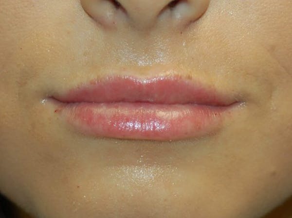 Restylane Before & After Gallery - Patient 4521062 - Image 2