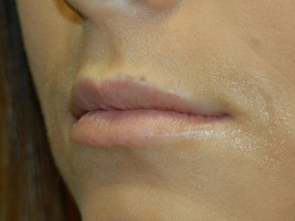 Restylane Before & After Gallery - Patient 4521062 - Image 3