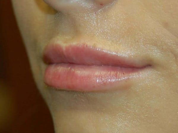 Restylane Before & After Gallery - Patient 4521062 - Image 4