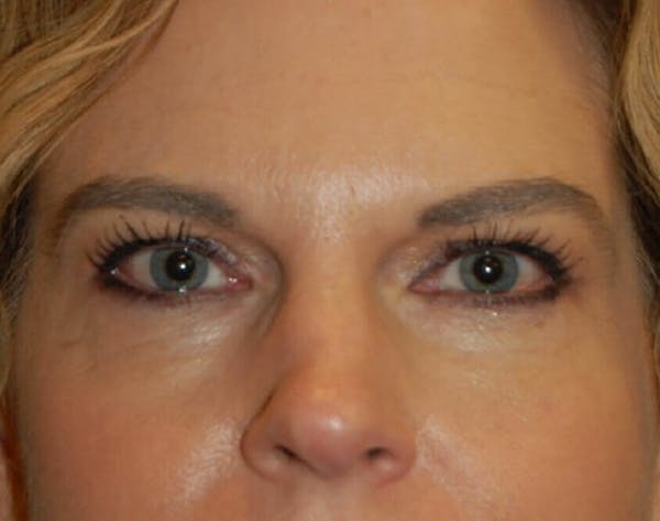 Chemical Peel Before & After Gallery - Patient 4521068 - Image 1