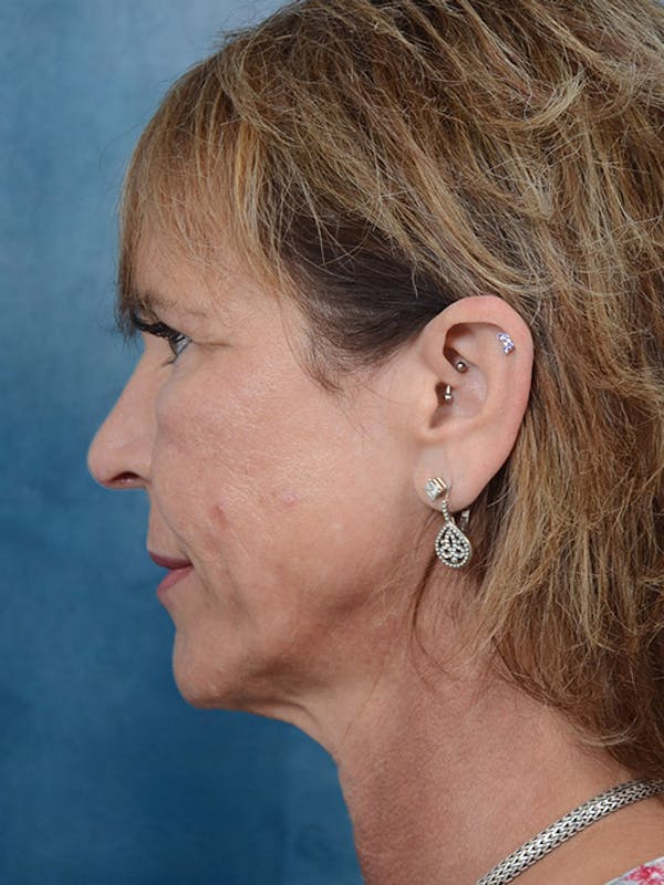 Laser Skin Resurfacing Before & After Gallery - Patient 4861587 - Image 5