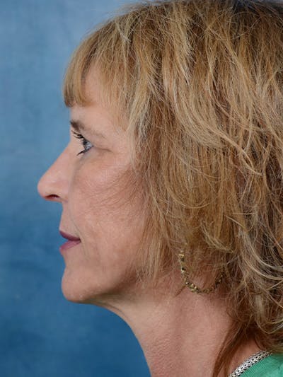 Laser Skin Resurfacing Before & After Gallery - Patient 4861587 - Image 6